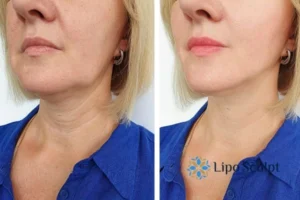 Double chin before and after Hi-Fu treatment 4 Book your double chin treatment Eastbourne today! We are here to help!