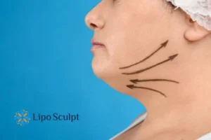 Double chin before and after Hi-Fu treatment 3 Boost your confidence with a Double chin treatment Eastbourne