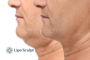 Double chin before and after Hi-Fu treatment 2 Double chin treatment Eastbourne from Lipo Sculpt - feel more confident today!
