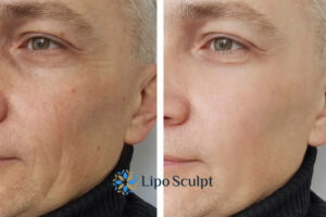 How to Fight Aging Symptoms 3 Fight Aging Symptoms Eastbourne With HIFU and Morpheus8 Today!