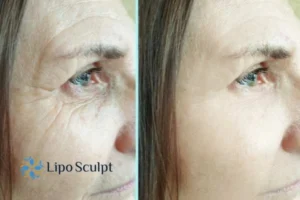 How to Fight Aging Symptoms 2 Do you want to Fight Aging Symptoms Eastbourne? Contact Lipo Sculpt today!