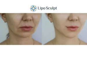 Explaining Total Skin Tightening Treatment And What It Can Do For You 2 Do you want to boost your self confidence? Give Morpheus8 Eastbourne a try today!