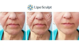 Explaining Total Skin Tightening Treatment And What It Can Do For You 3 Boost your confidence with Morpheus8 Eastbourne call our team today!