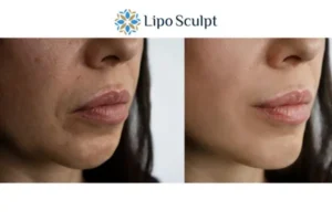 Explaining Total Skin Tightening Treatment And What It Can Do For You 4 Morpheus8 Eastbourne the best results - call our team today!