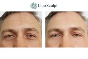 Explaining Total Skin Tightening Treatment And What It Can Do For You 6 Morpheus8 Eastbourne book in today to find out more!