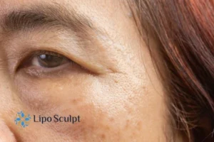 Cryopen: The Revolutionary Treatment for Age Spots Unveiled 2 Are age spots Eastbourne giving you low self esteem? Contact us today!