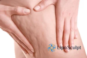 CoolSculpting for Legs: The Innovative Approach to Redefining Your Legs 5 Start your journey today book your coolsculpting treatment Eastbourne online today!